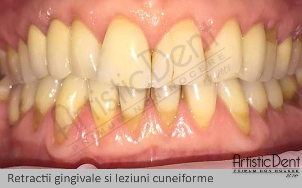 carii dentare, durere dentara, clinica stomatologica Artistic Dent Bucuresti