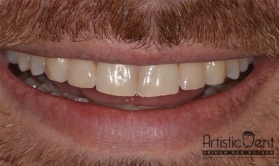 implant dentar Straumann, clinica stomatologica Artistic Dent Bucuresti