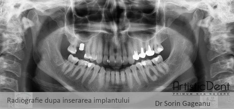 implant dentar Straumann, clinica stomatologica Artistic Dent Bucuresti
