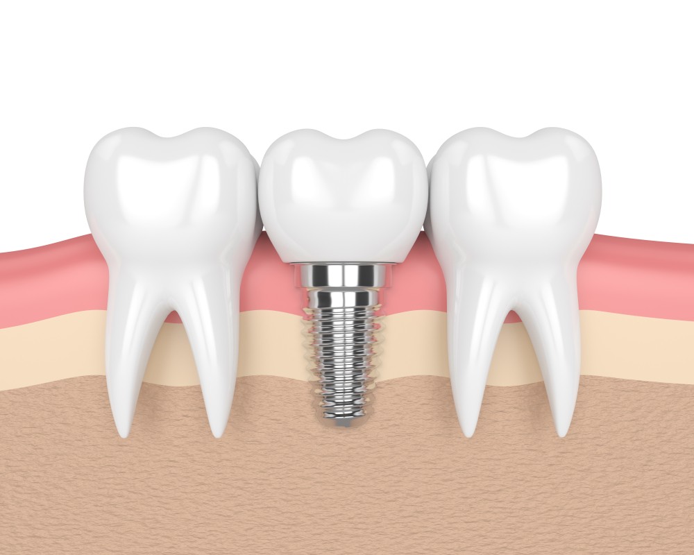 implant dentar Straumann