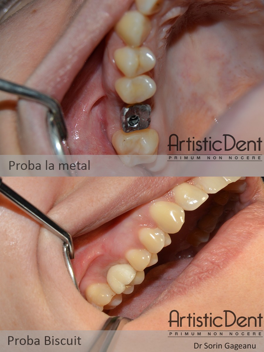 implant dentar Straumann Roxolid, clinica stomatologica Artistic Dent Bucuresti