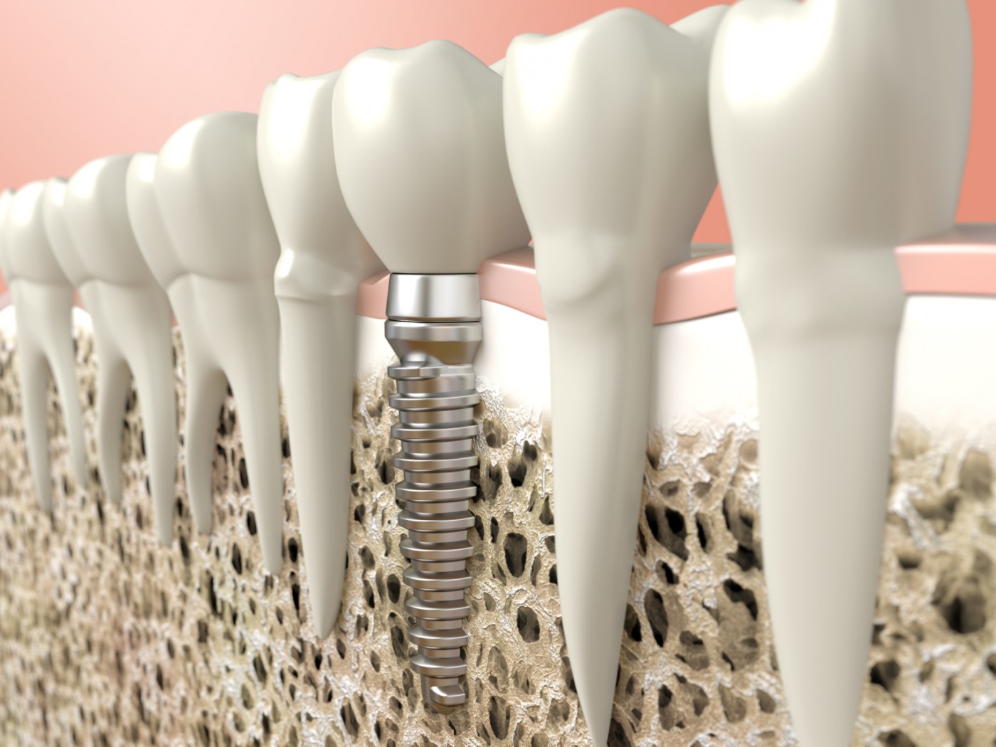 implant dentar Straumann