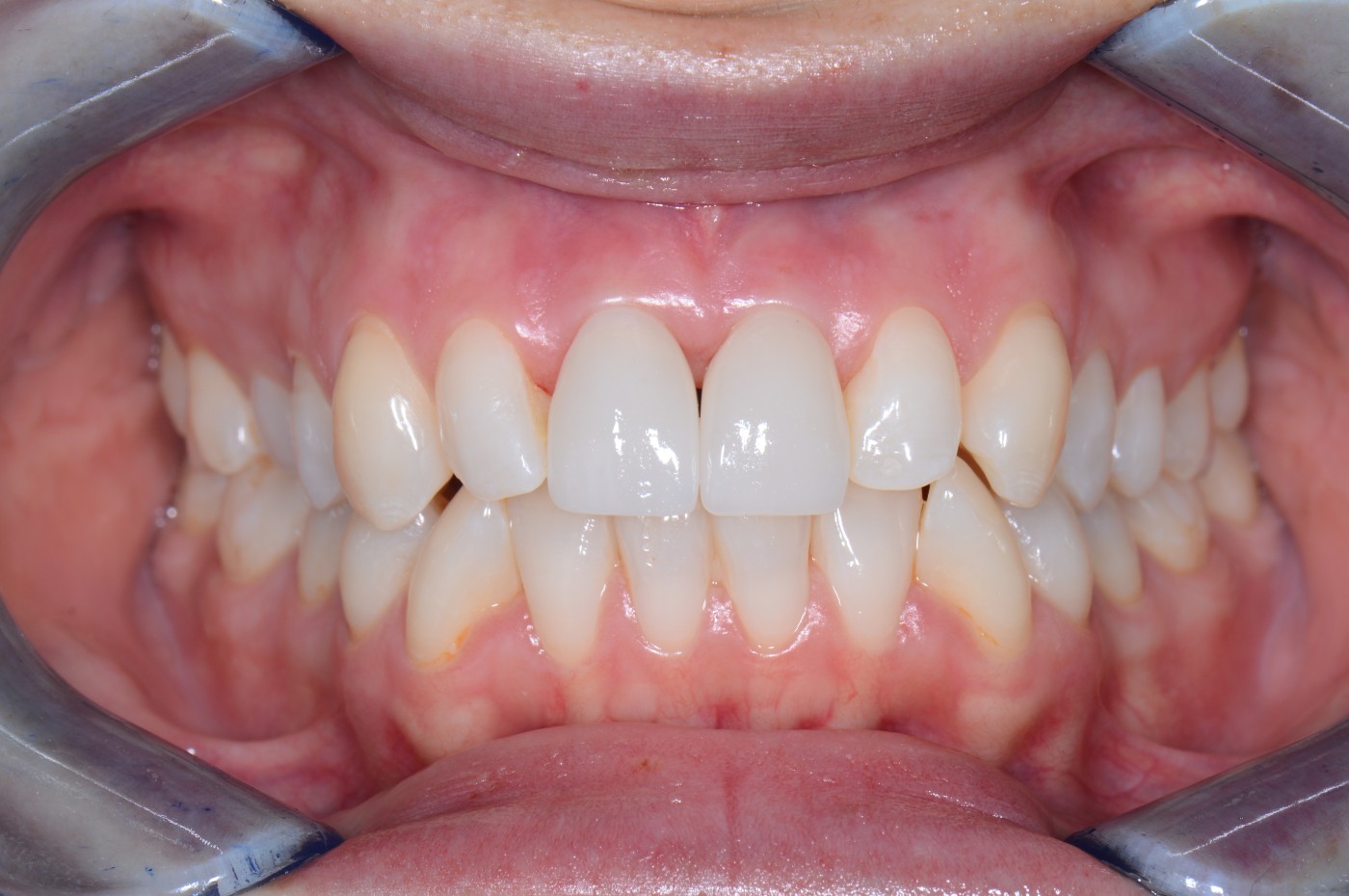 implant zirconiu, implant dentar zirconiu, implanturi de zirconiu, recuperare dupa implant dentar