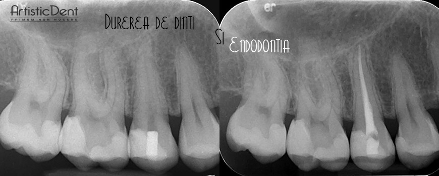 tratament de canal, durere dentara, endodontie