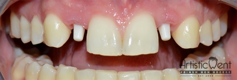 implant dentar Straumann, clinica stomatologica Artistic Dent Bucuresti