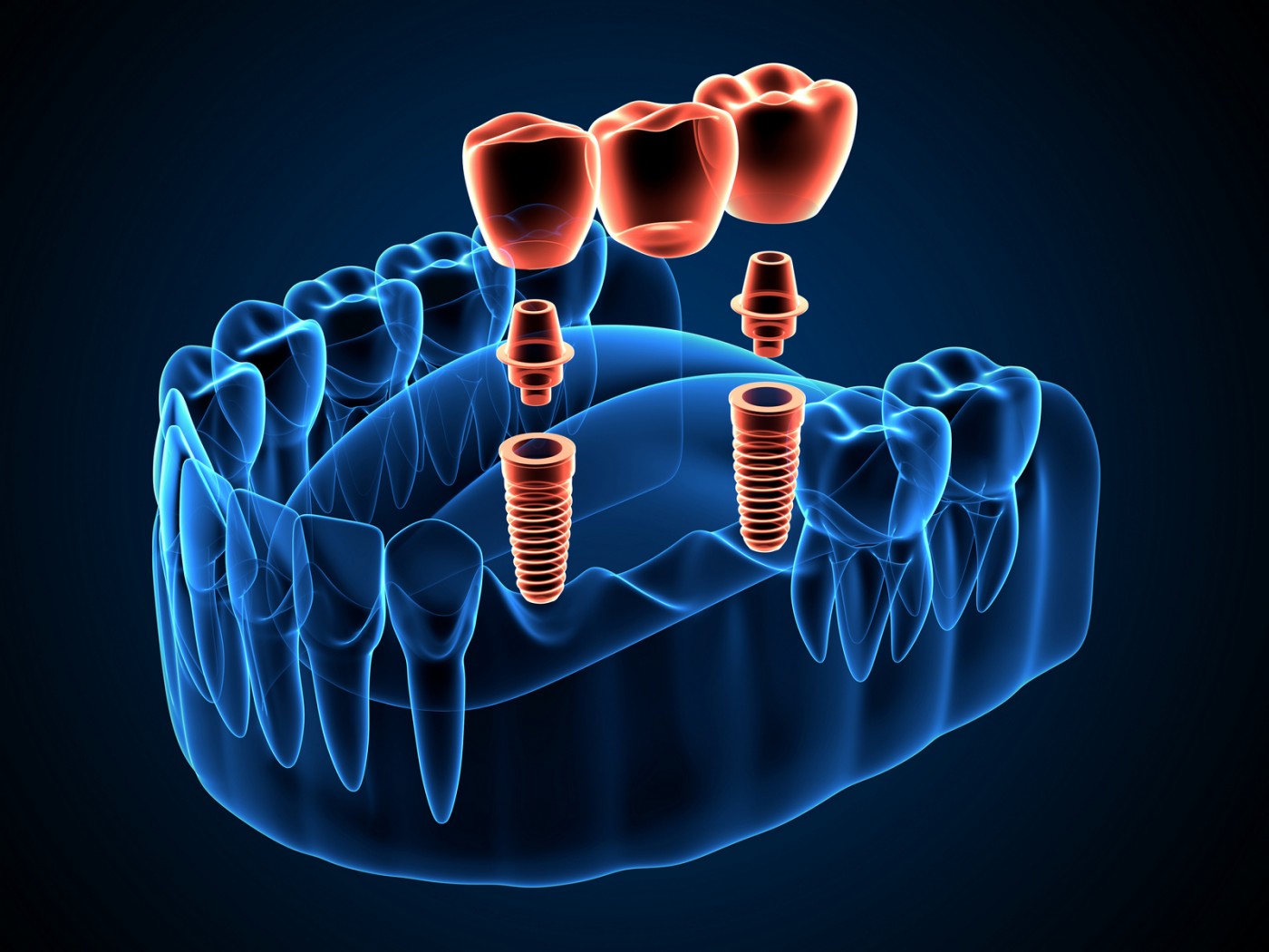 Implant dentar Straumann