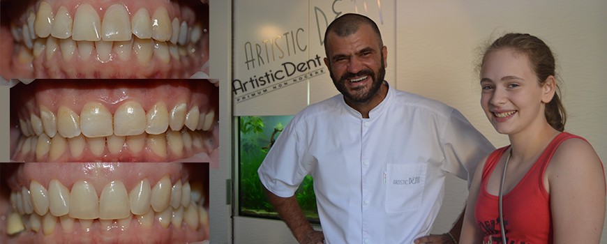 obturatii dentare dinti frontali