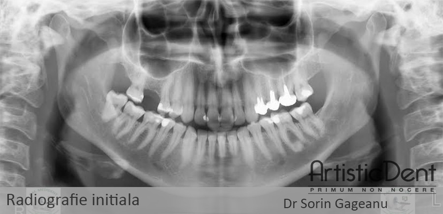 implant dentar Straumann Roxolid, clinica stomatologica Artistic Dent Bucuresti