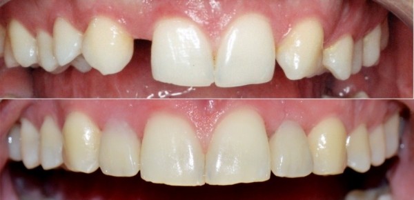 implant dentar Straumann, clinica stomatologica Artistic Dent Bucuresti