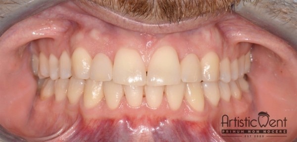 implant dentar Straumann, clinica stomatologica Artistic Dent Bucuresti