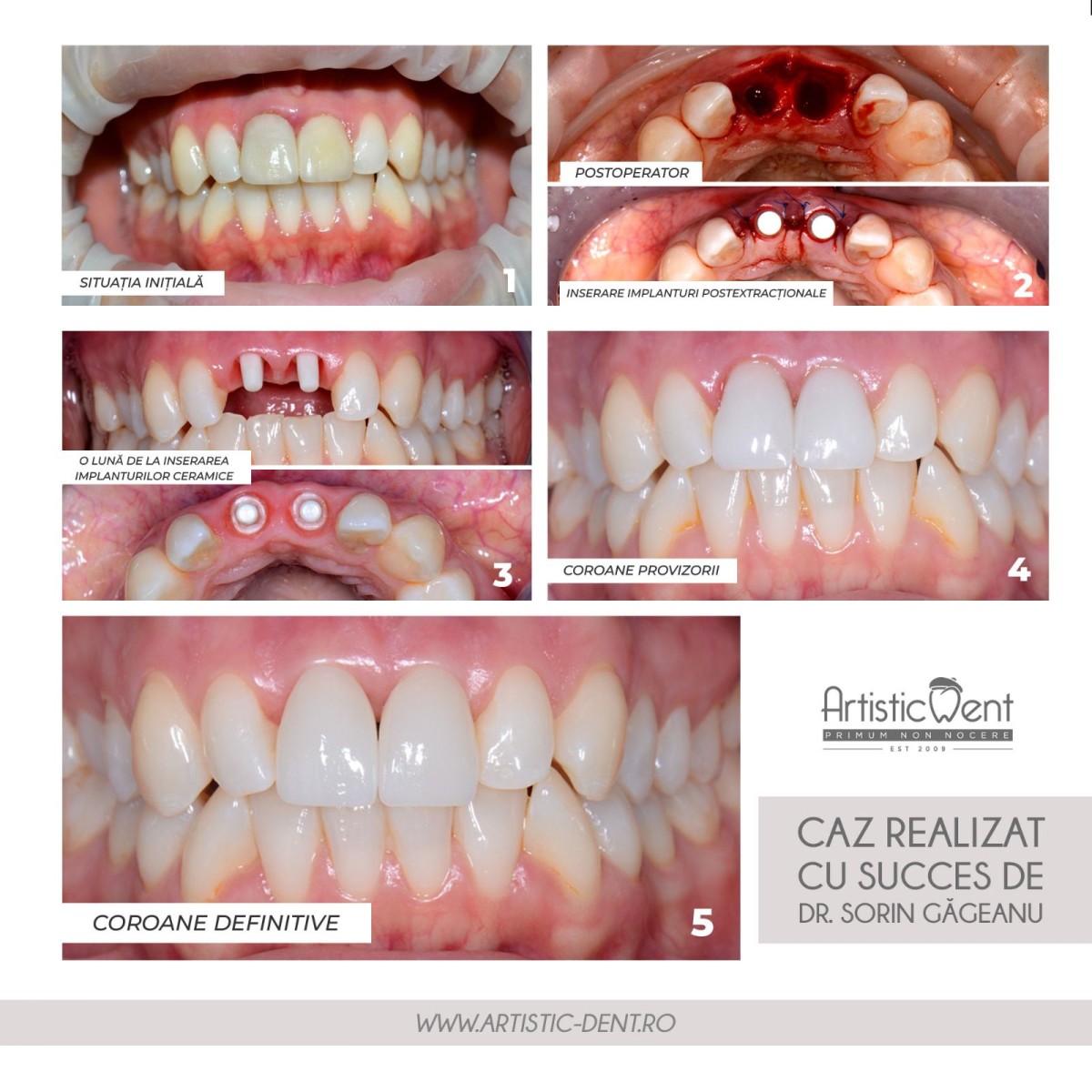implant zirconiu, implant dentar zirconiu, implanturi de zirconiu, recuperare dupa implant dentar