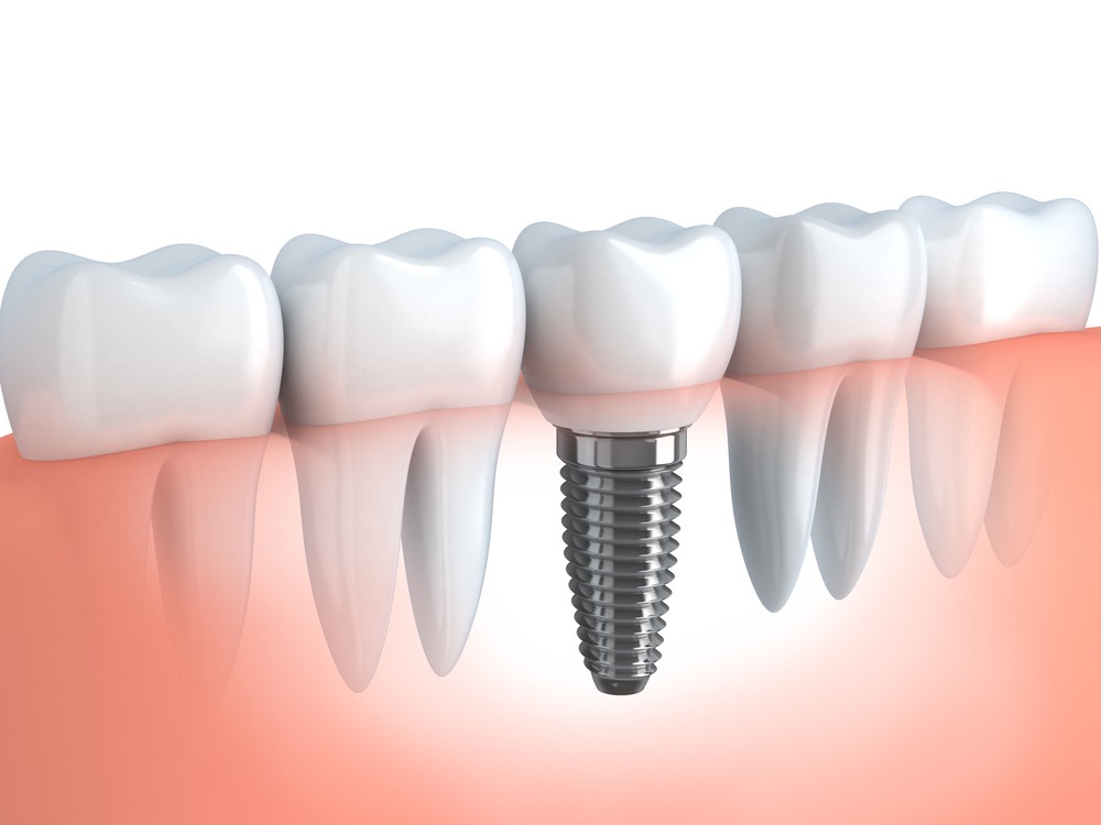 Implant dentar Straumann
