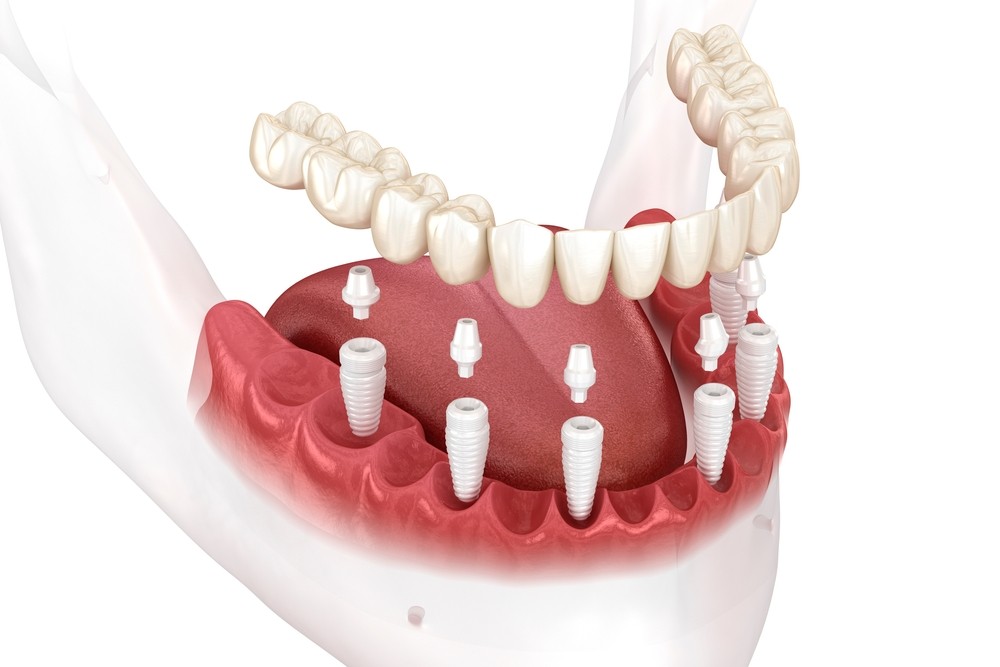 implant dentar ceramic, implant pure ceramic