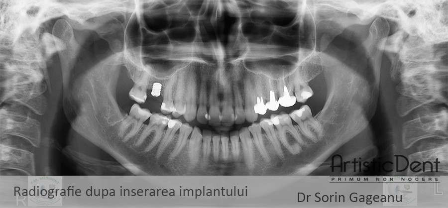 implant dentar Straumann