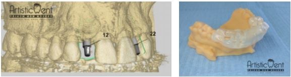 implant dentar Straumann, clinica stomatologica Artistic Dent Bucuresti
