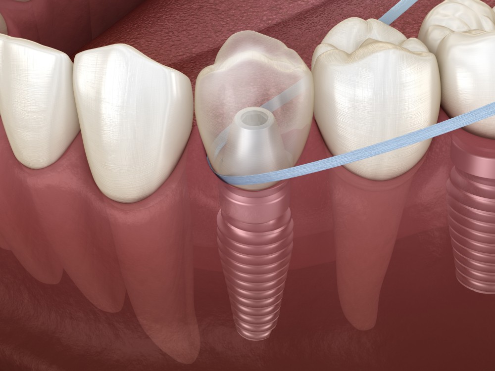 implant dentar Straumann
