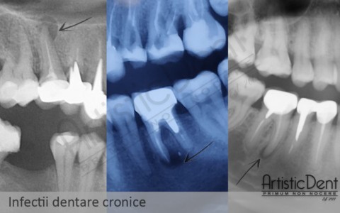 carii dentare, durere dentara, clinica stomatologica Artistic Dent Bucuresti