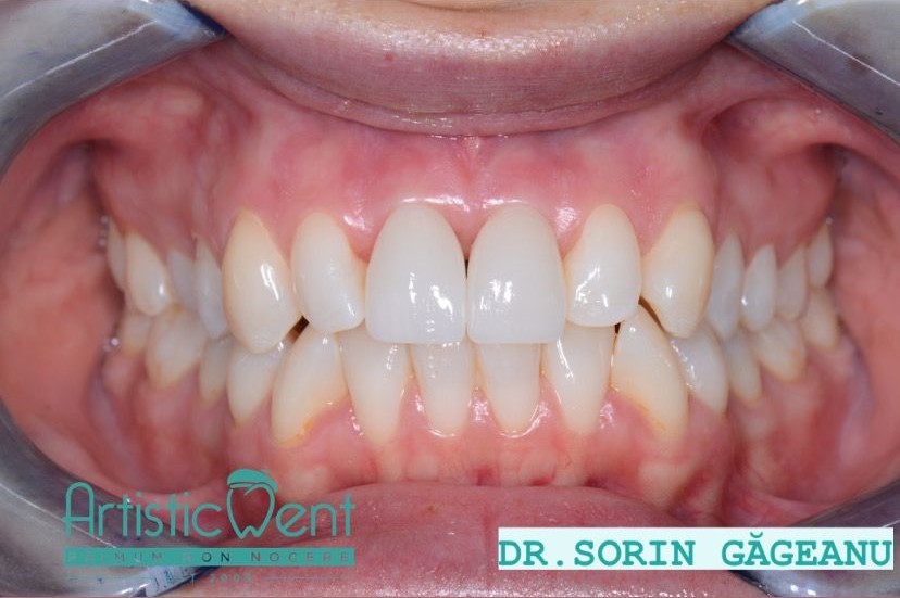 implant zirconiu, implant dentar zirconiu, implanturi de zirconiu, recuperare dupa implant dentar