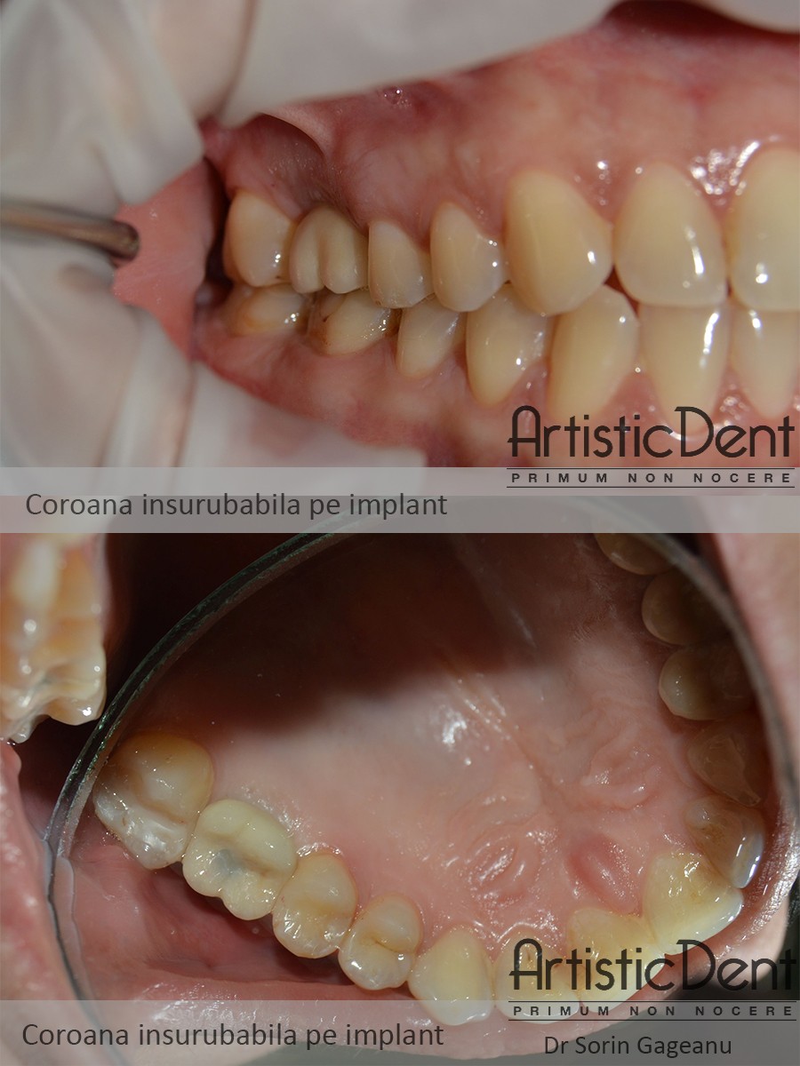 implant dentar Straumann Roxolid, clinica stomatologica Artistic Dent Bucuresti
