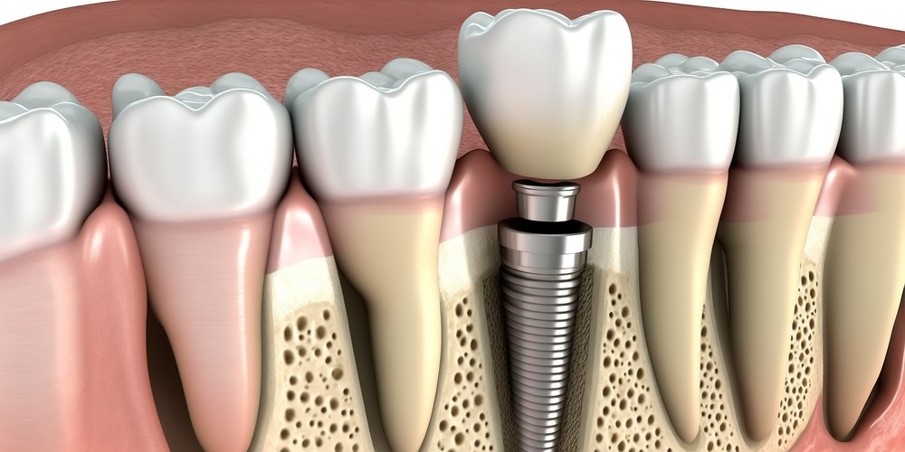 implant dentar Straumann