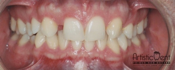 implant dentar Straumann, clinica stomatologica Artistic Dent Bucuresti