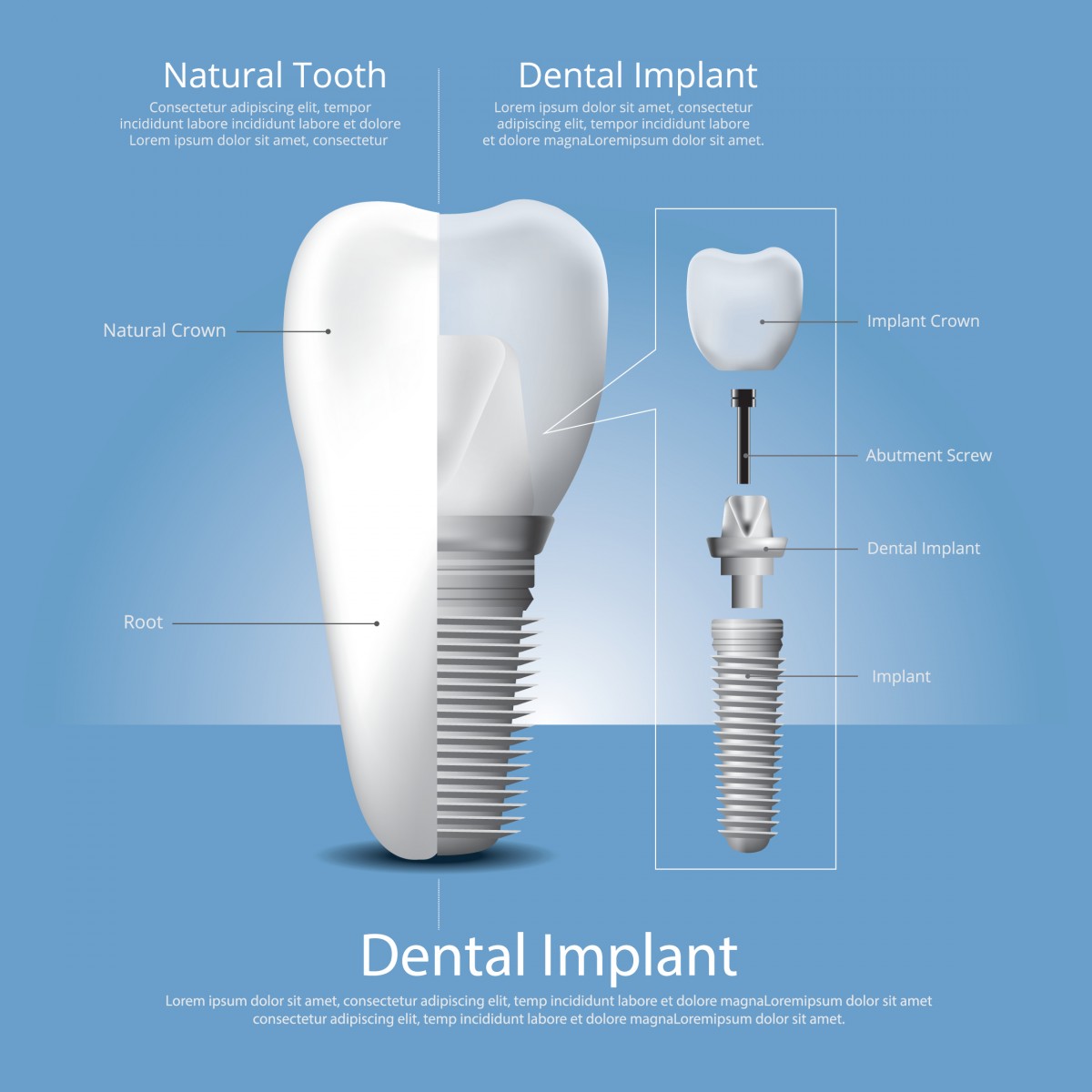 implant dentar Straumann