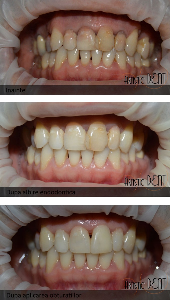 obturatii dentare dinti frontali