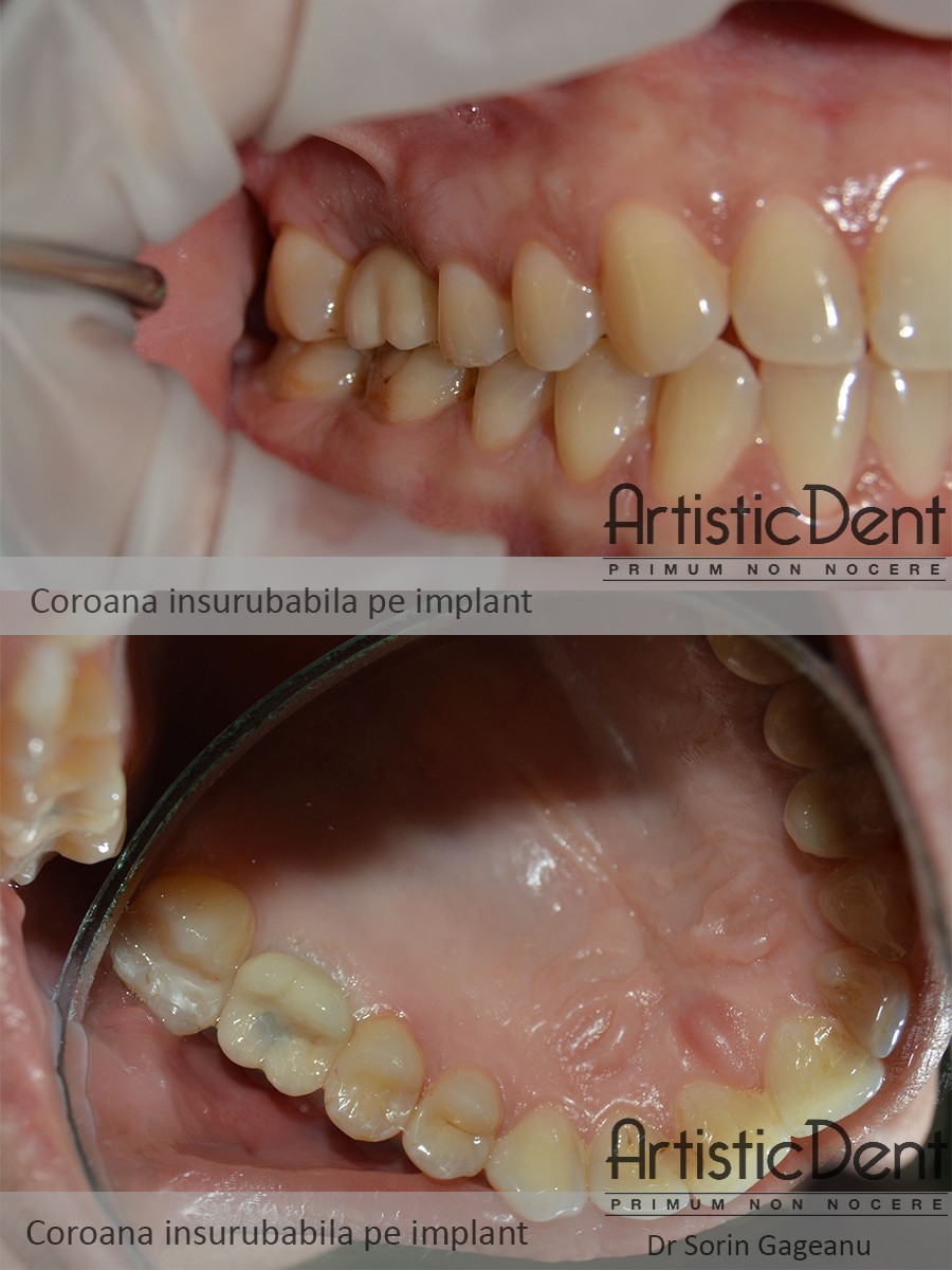 implant dentar Straumann