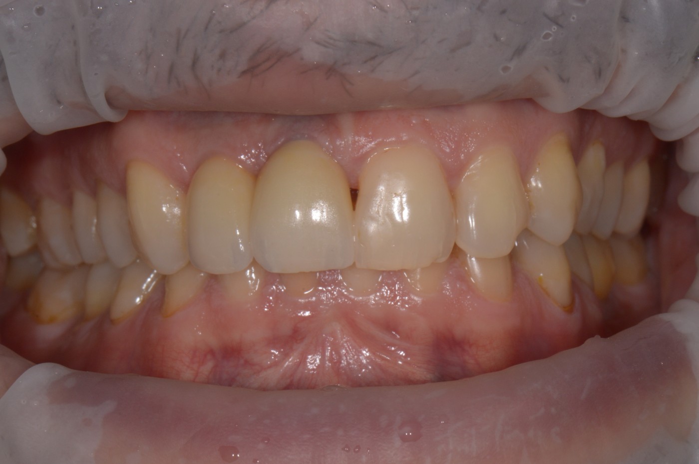 implant zirconiu, implant dentar zirconiu, implanturi de zirconiu, recuperare dupa implant dentar